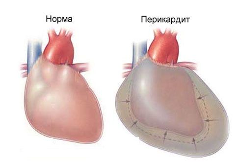 Viêm màng ngoài tim cấp tính và đau ngực ở bên trái
