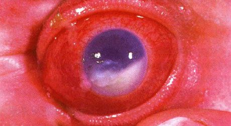 Hypopion đi cùng endophthalmitis