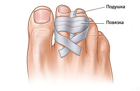 Triển vọng phục hồi những ngón chân bị hỏng là gì?