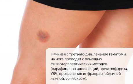 Điều trị tụ máu ở chân