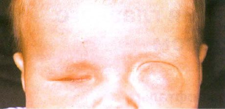 Viêm mắt nhỏ kèm theo sự hình thành nang (mắt trái). Viêm mắt không có nhãn cầu (mắt phải).