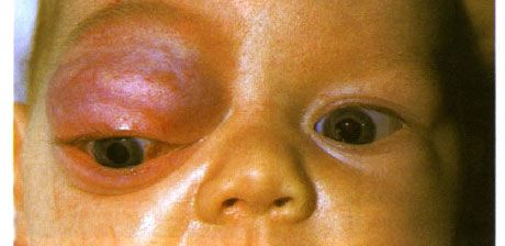 Mao mạch máu ở phần trước của quỹ đạo và mí trên.  Neoplasm có xu hướng tiến bộ