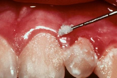 Răng và viêm nướu