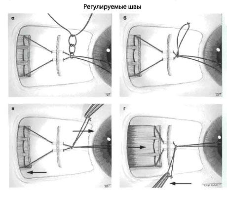 Strabismus - Hoạt động