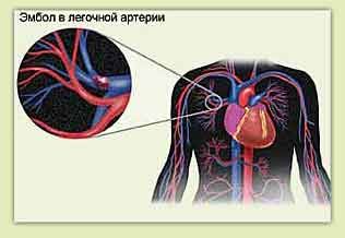 Thuyên tắc phổi và đau ngực ở bên trái