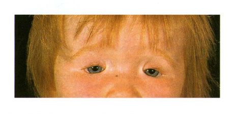 Sỏi hai bên của mí mắt ở trẻ bị hội chứng vàng.  Đóng cửa khe mắt ở bên trái